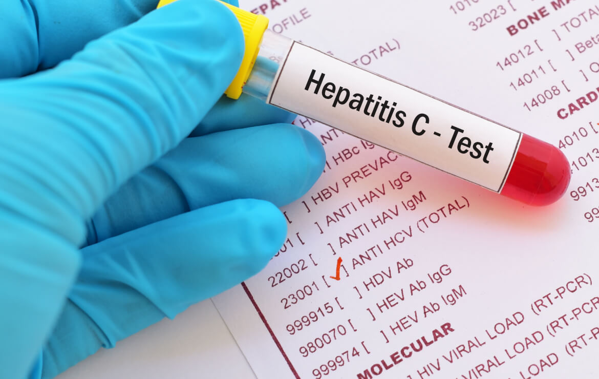Hepatitis C test